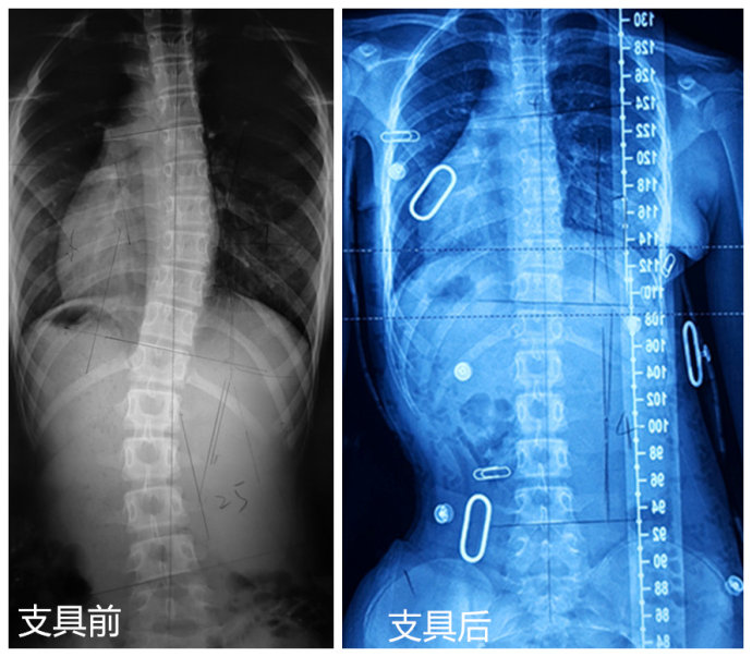 世界首例可穿戴的3D打印脊柱側彎支具在我工作室誕生! 世界首例可穿戴的3D打印脊柱側彎支具在我工作室誕生!