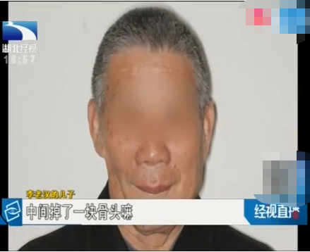 華中首例!3D打印鈦合金下頜骨植入74歲老人面部 華中首例!3D打印鈦合金下頜骨植入74歲老人面部