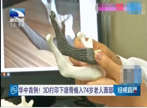華中首例!3D打印鈦合金下頜骨植入74歲老人面部 華中首例!3D打印鈦合金下頜骨植入74歲老人面部
